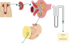 Microalbuminúria: o que é, causas