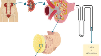 Microalbuminúria: o que é, causas